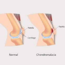 Condromalácia da patela (Rótula)