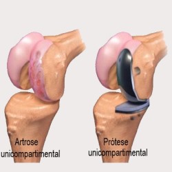 Prótese parcial do joelho